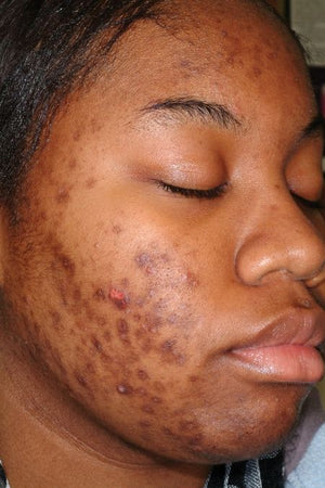 Dry Skin
