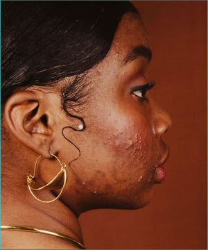 Rough Skin